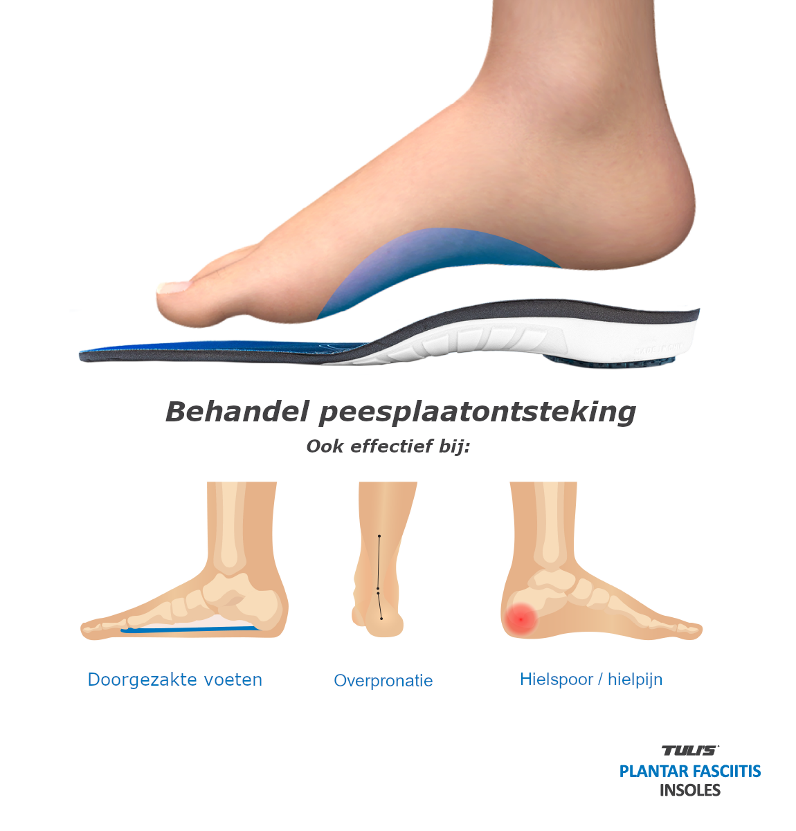 Tuli's Peesplaatontsteking steunzolen / Plantar Fascia